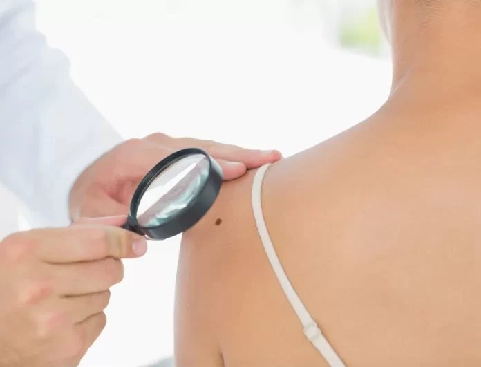 Eλιές στο δέρμα: Πότε πρέπει να ανησυχήσετε για το αν είναι καρκίνος