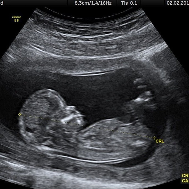 Ο Justin Bieber και η Hailey Baldwin θα γίνουν γονείς