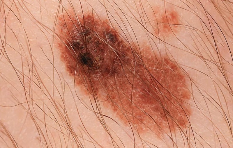 Καρκίνος του δέρματος: Ποια είναι τα συμπτώματα; Προσοχή! Εικόνες-σοκ!