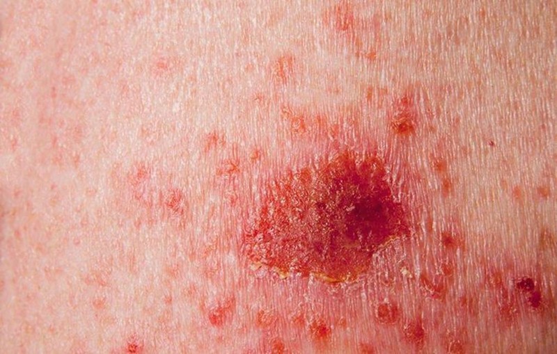 Καρκίνος του δέρματος: Ποια είναι τα συμπτώματα; Προσοχή! Εικόνες-σοκ!