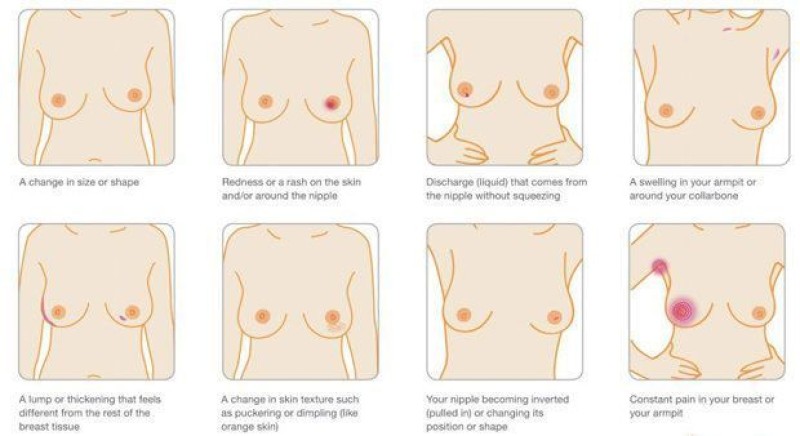Κορίτσια προσοχή! 8+1 συμπτώματα του καρκίνου του μαστού που δεν πρέπει να αγνοήσετε!