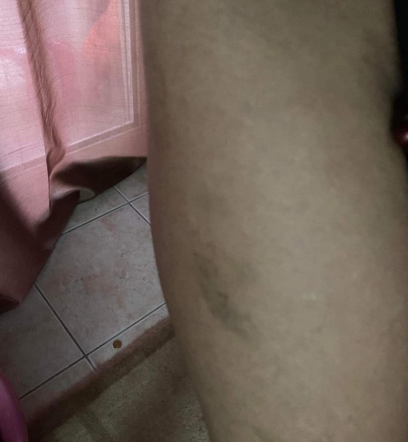 Βιασμός 24χρονης Θεσσαλονίκη φωτογραφίες με μώλωπες