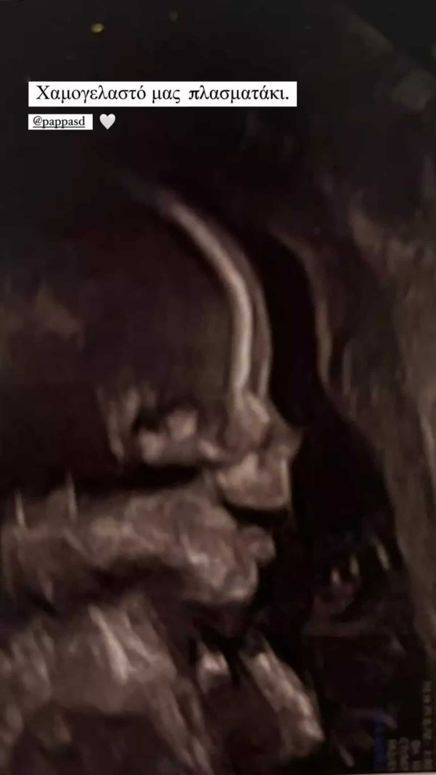 Αννα Μπεζαν υπερηχογράφημα