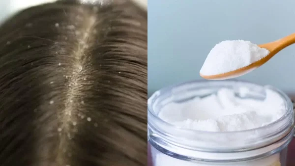 Μέσα σε δυο εβδομάδες θα έχεις δει διαφορά: Εξαφάνισε την πιτυρίδα με μαγειρική σόδα