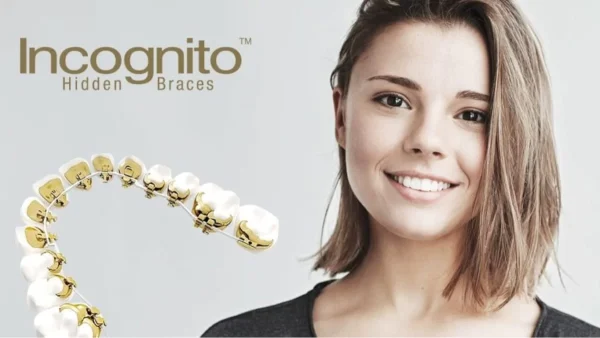 Μάθε τα πάντα για την αόρατη γλωσσική ορθοδοντική!