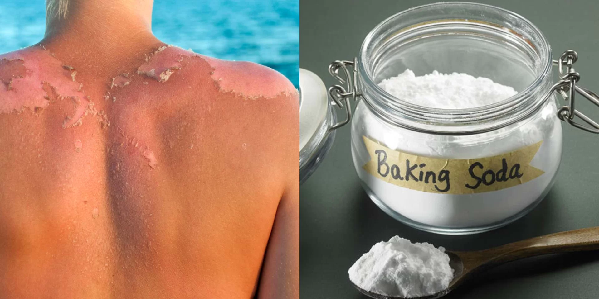 Έπαθες έγκαυμα μετά από την παραλία; Ανακούφισε τον πόνο μόνο με μαγειρική σόδα