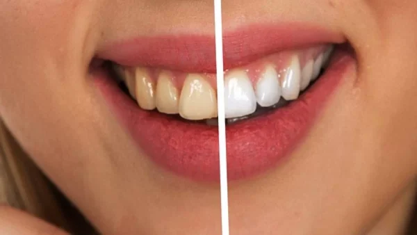 Μόνο με μαγειρική σόδα και ένα ακόμη συστατικό θα δεις το επιθυμητό αποτέλεσμα - Λευκά δόντια μέσα σε λίγα λεπτά