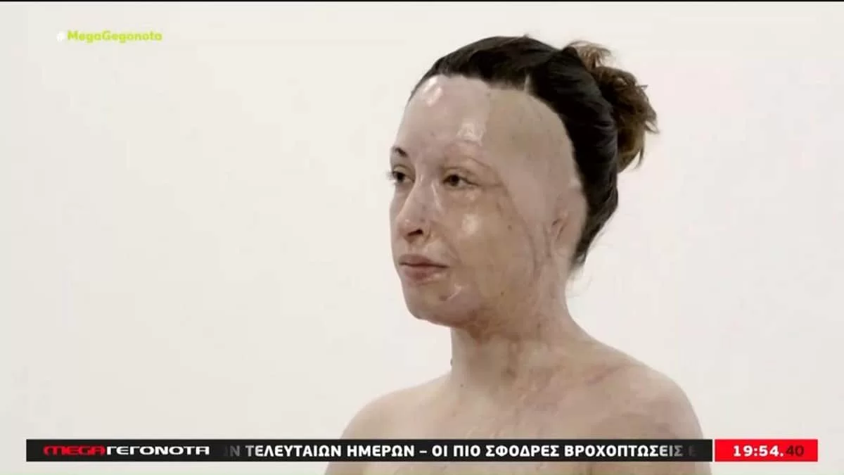 Επίθεση Μεσσήνη: «Σε ό,τι χρειαστεί θα...» - Οι συγκινητικές δηλώσεις της Παλιοσπύρου για τη γυναίκα που δέχτηκε επίθεση με καυστικό υγρό