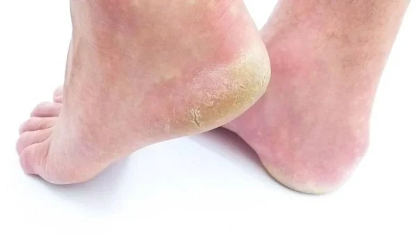 Είναι σκληρές και αντιαισθητικές; Το απόλυτο υλικό που θα κάνει την διαφορά στις φτέρνες σου