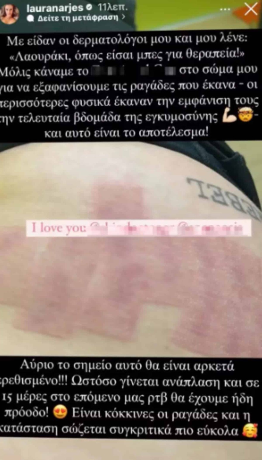 Τα σημάδια που απέκτησε στο σώμα της κατά την περίοδο της εγκυμοσύνης