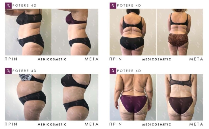 μέθοδος Potere 4D