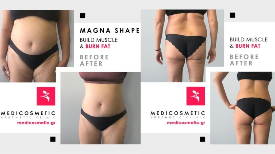 Magna Shape των Medi Cosmetic