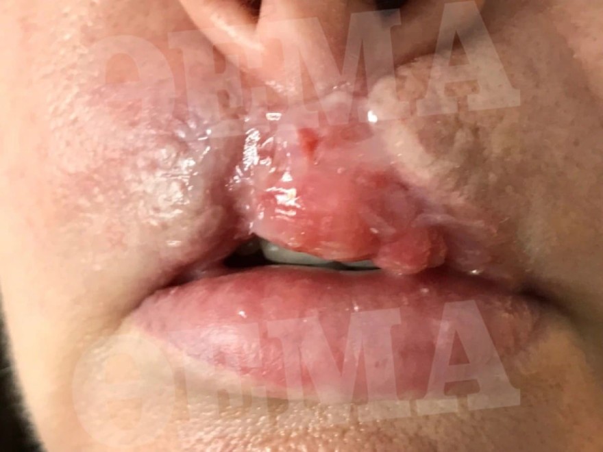 Κατερίνας Πλουμιδάκη πλαστική