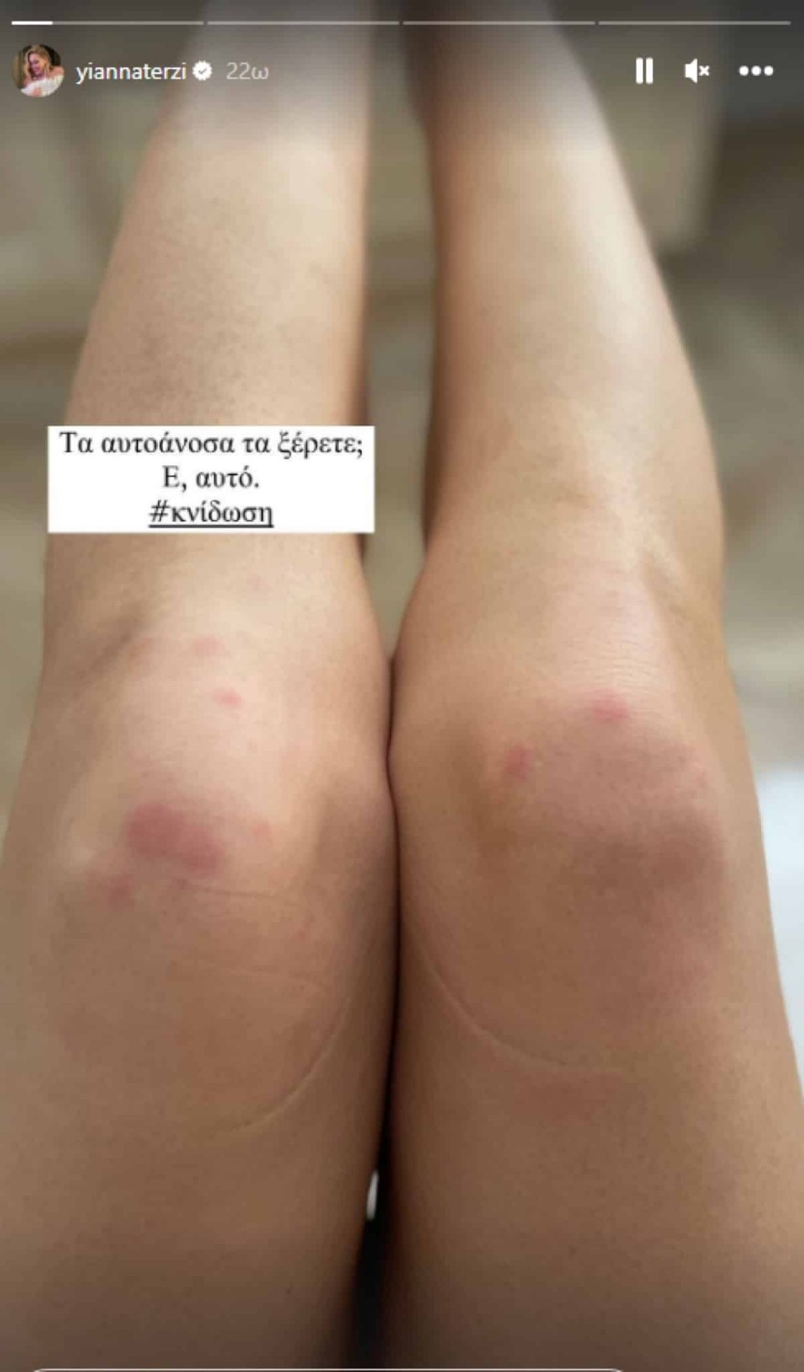 Αυτοάνοσο - Τερζή