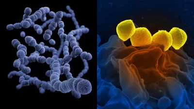 Στρεπτόκοκκος: Αυτό είναι το νούμερο 1 σύμπτωμα για να καταλάβατε αν πάσχετε