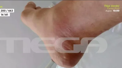 Κακοκαιρία Daniel: Μετά τα κρούσματα με δερματικές παθήσεις - Υποφέρουν από γαστρεντερίτιδα οι πληγέντες