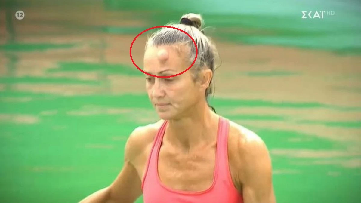 Survivor spoiler 27/2: Στο νοσοκομείο εκτάκτως η Δώρα Νικολή - Το εξόγκωμα στο κεφάλι και οι φήμες για αποχώρηση