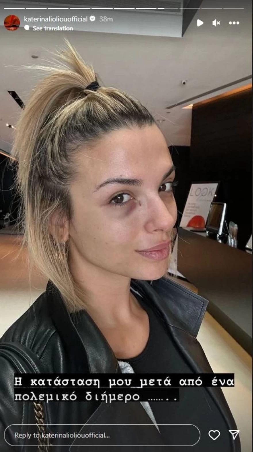 Κατερίνα Λιόλιου μαυρισμένο μάτι