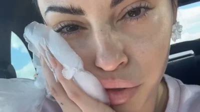 Σοβαρό ατύχημα για τη Δήμητρα Αλεξανδράκη (Βίντεο) - Πρήστηκε το μισό της πρόσωπο: «Λες και έχω κάνει αποτυχημένο υαλουρονικό είμαι»