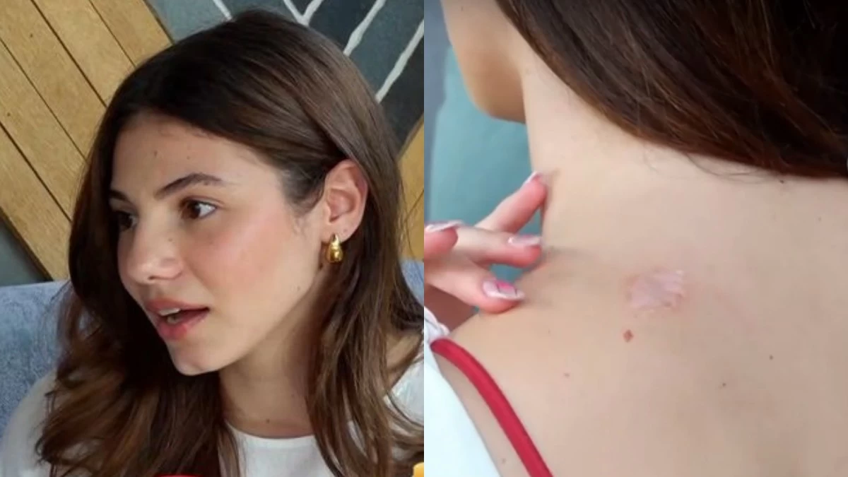 Μαριαγάπη Ξυπολιά: «Το προλάβαμε στο τσακ, θα γινόταν μελάνωμα και θα τρέχαμε για θεραπείες»