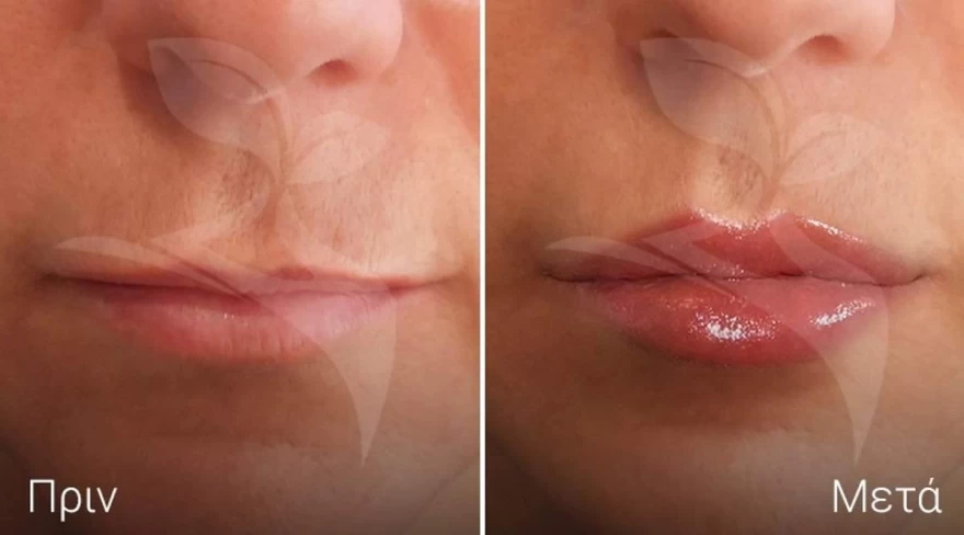 lip filler medicosmetic.gr