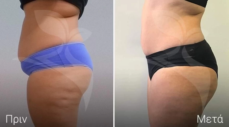 λιπογλυπτική θεραπεία medicosmetic.gr