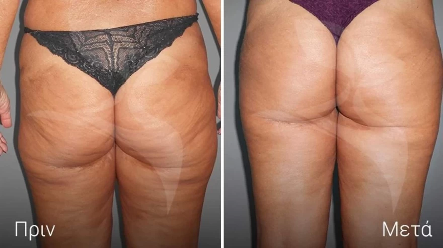 orange power Θεραπεία medicosmetic.gr