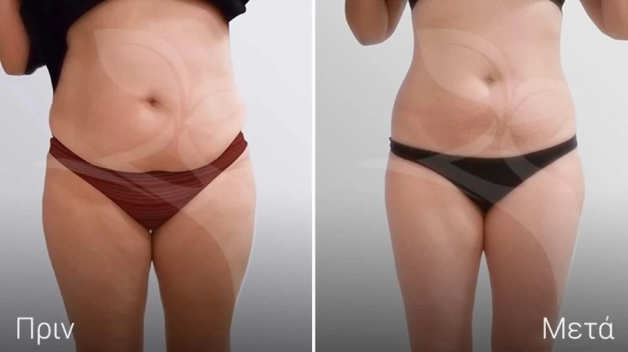 θεραπεία σώματος medicosmetic.gr