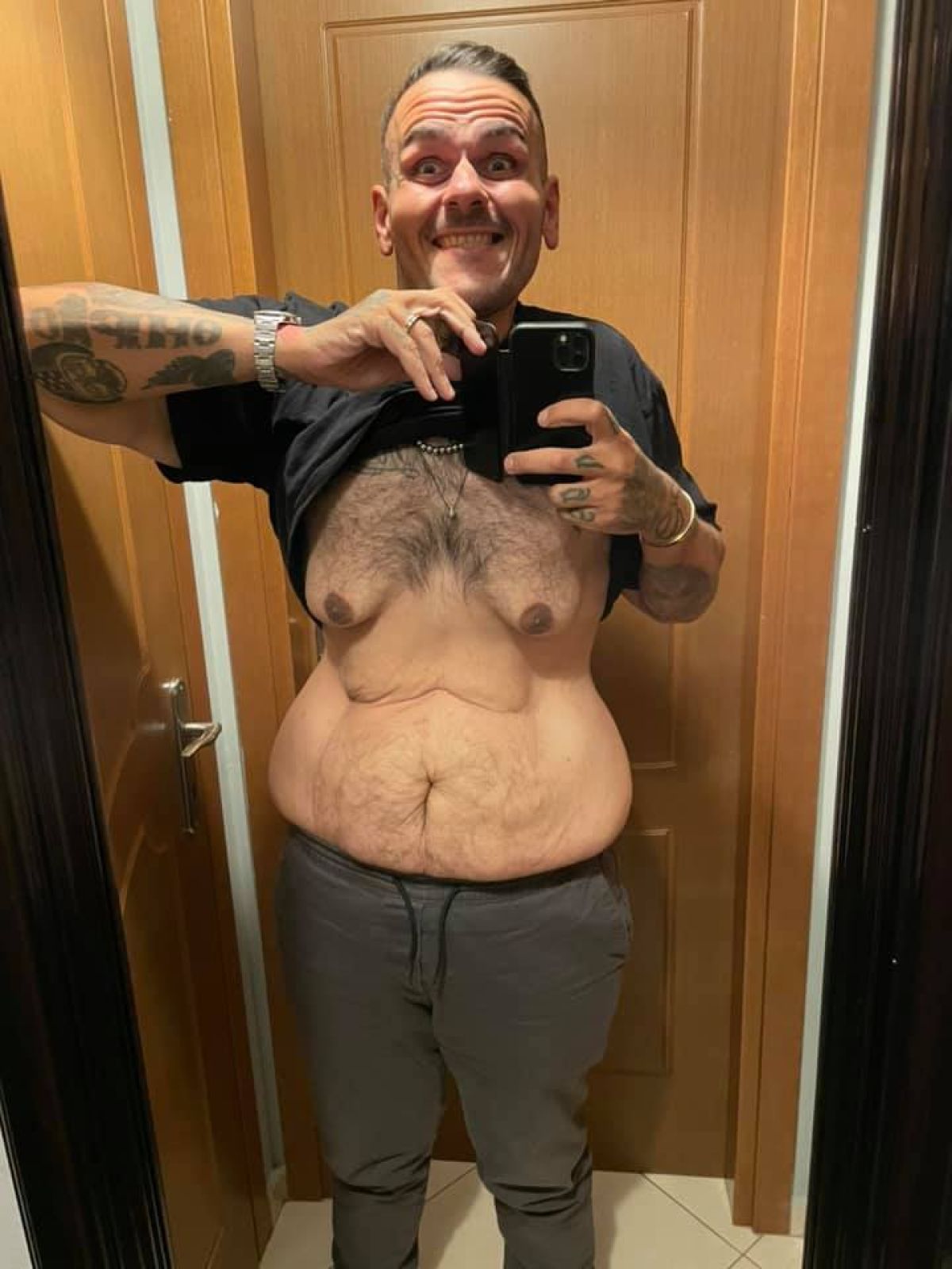 Το θηρίο μετά το γαστρικό μανίκι