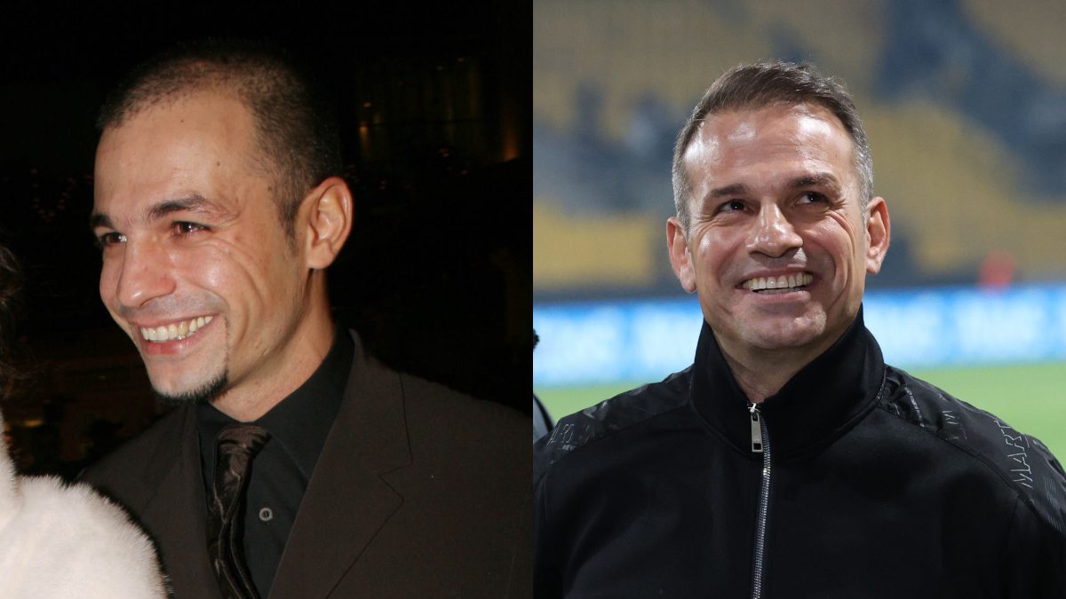 Ο Ντέμης Νικολαϊδης πριν και μετά την εμφύτεση μαλλιών