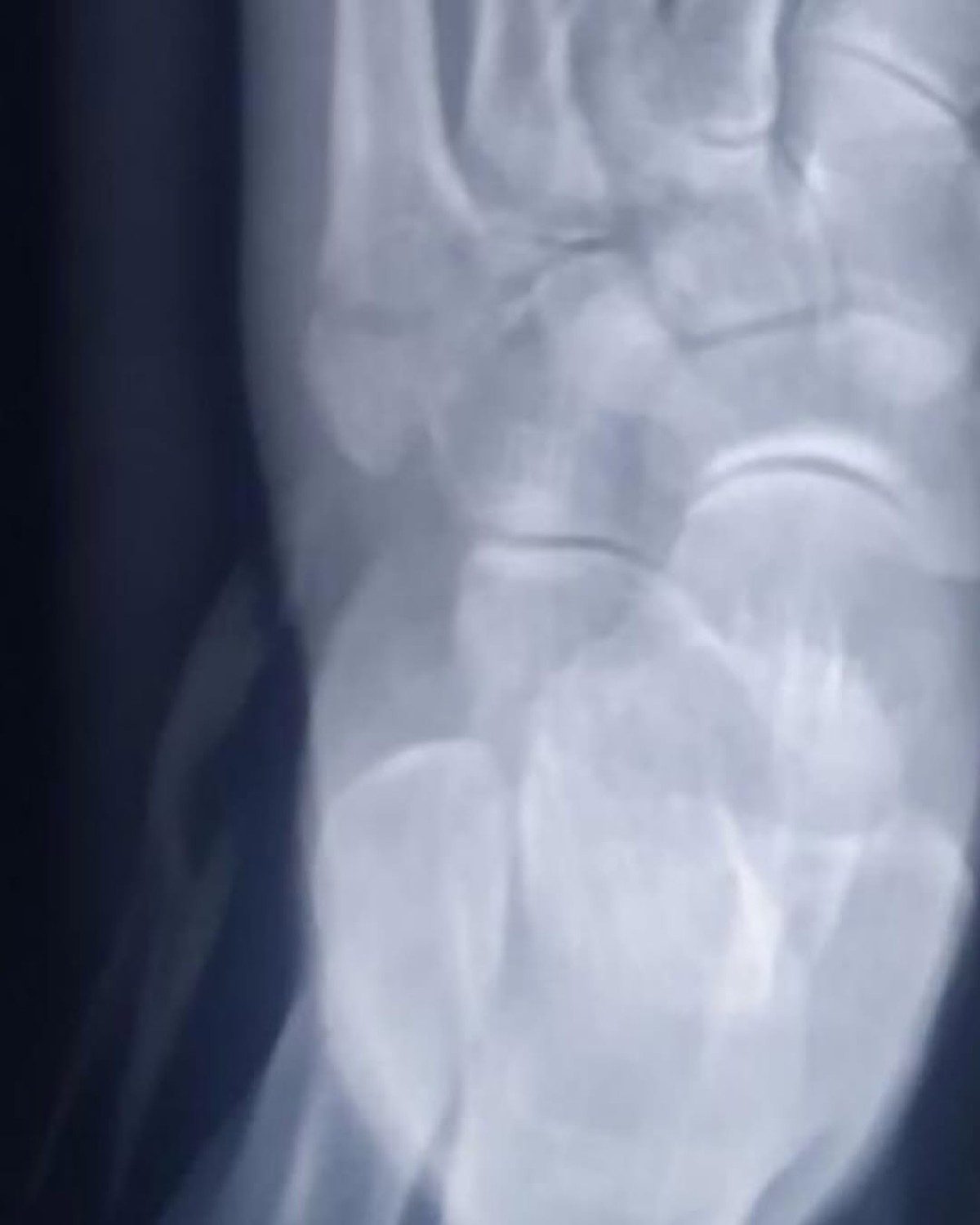 Η ακτινογραφία ποδιού της Μαρίνας Σάττι