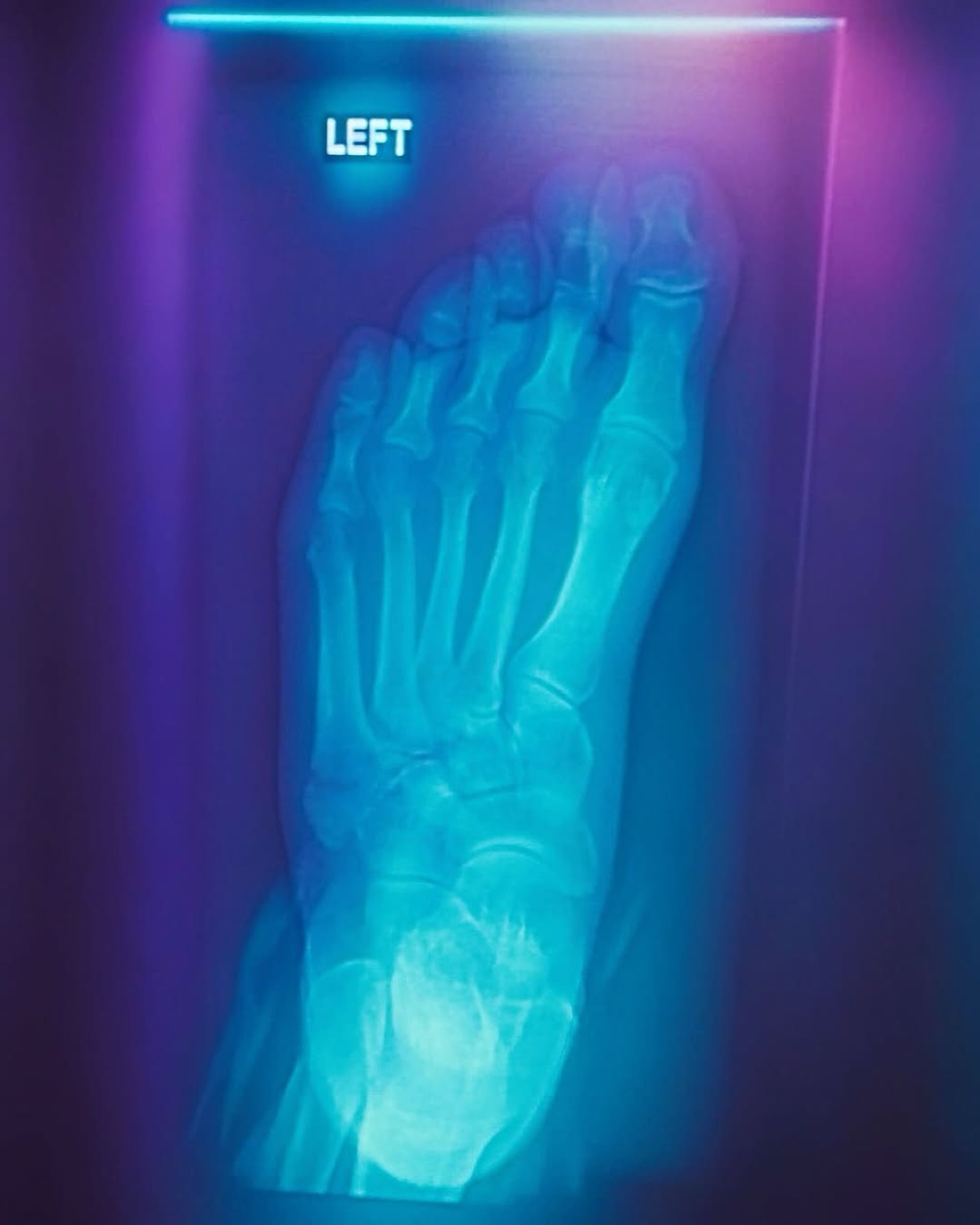 Η ακτινογραφία ποδιού της Μαρίνας Σάττι