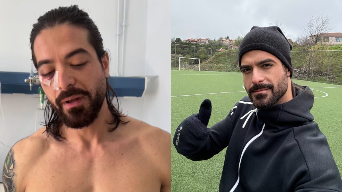 Ο Άρης Μουγκοπέτρος μετά και πριν το ατύχημα με την κροτίδα