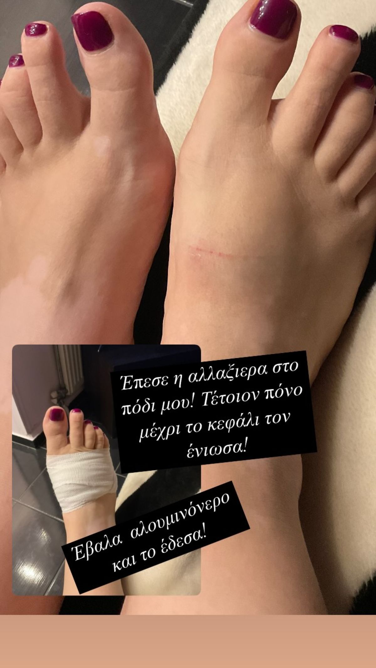 Το πόδι της Όλγας Κιουρτσάκη μετά το ατύχημα στο σπίτι της