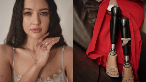 Δυο γυναίκες με σημάδια από τον πόλεμο