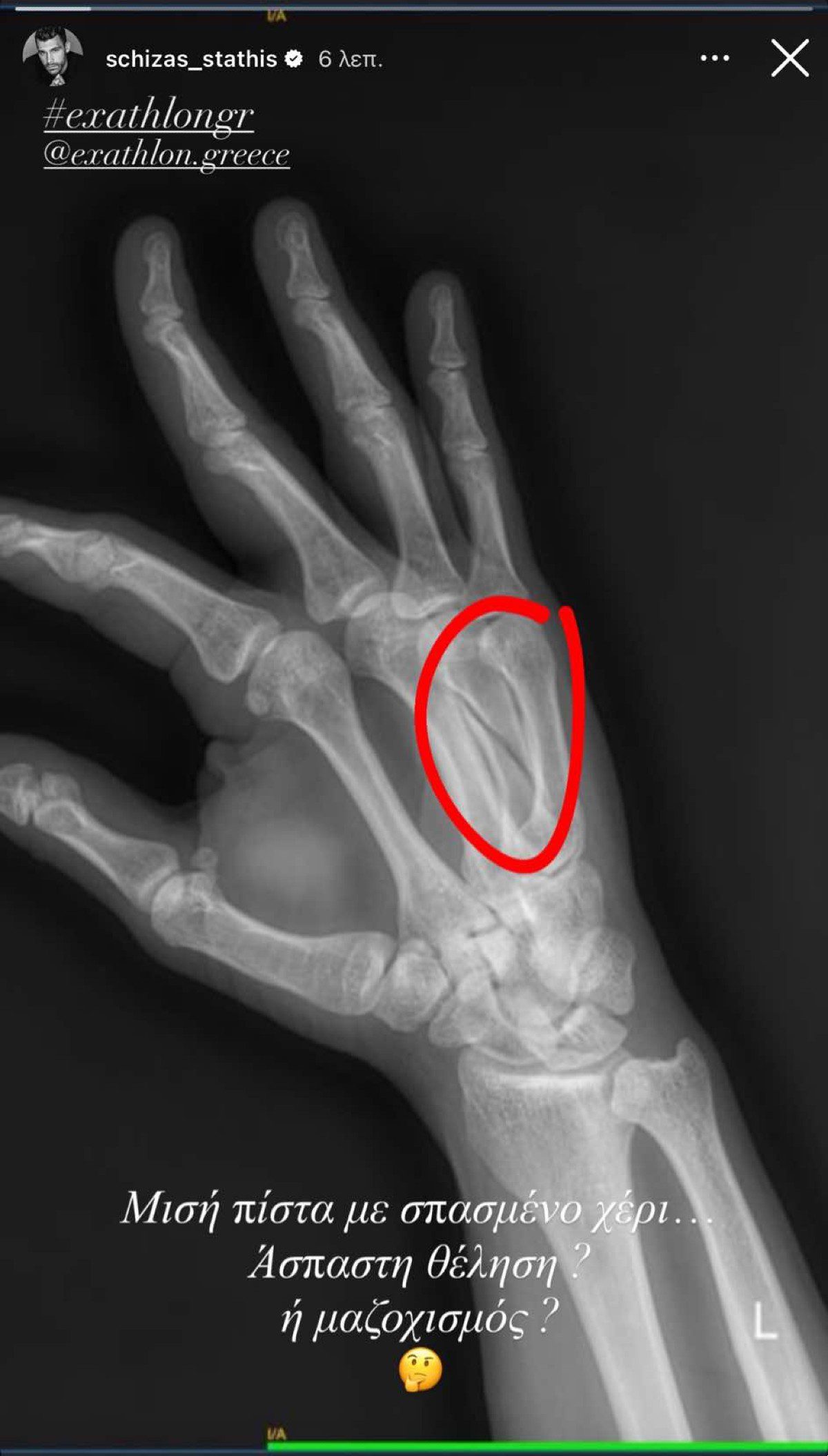 Η ακτινογραφία με το σπασμένο χέρι του Στάθη Σχίζα