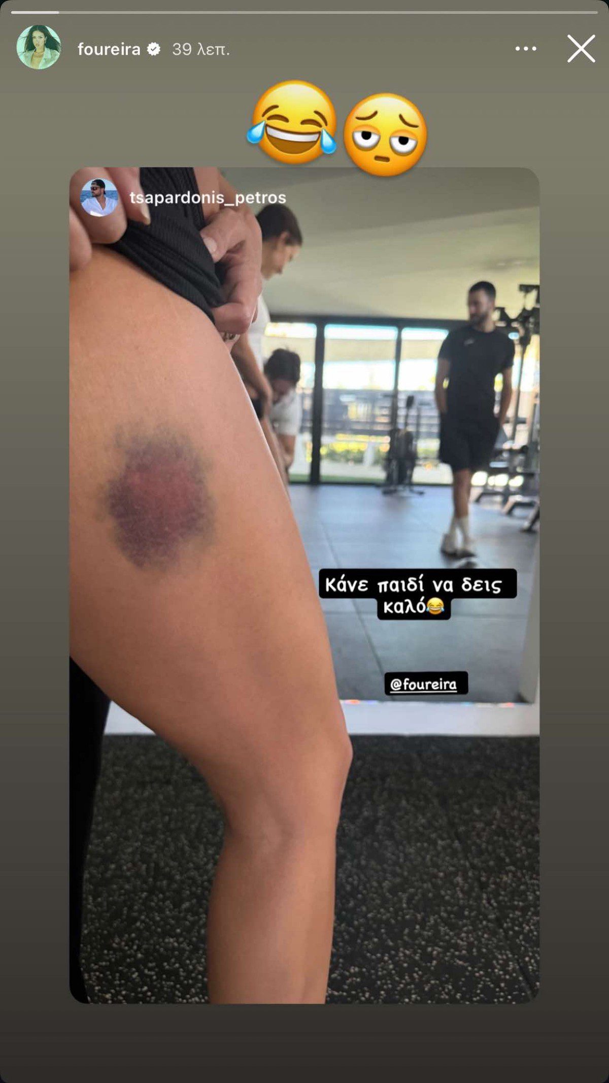 Η μελανιά που έκανε ο γιος της Ελένης Φουρέιρα στην ίδια