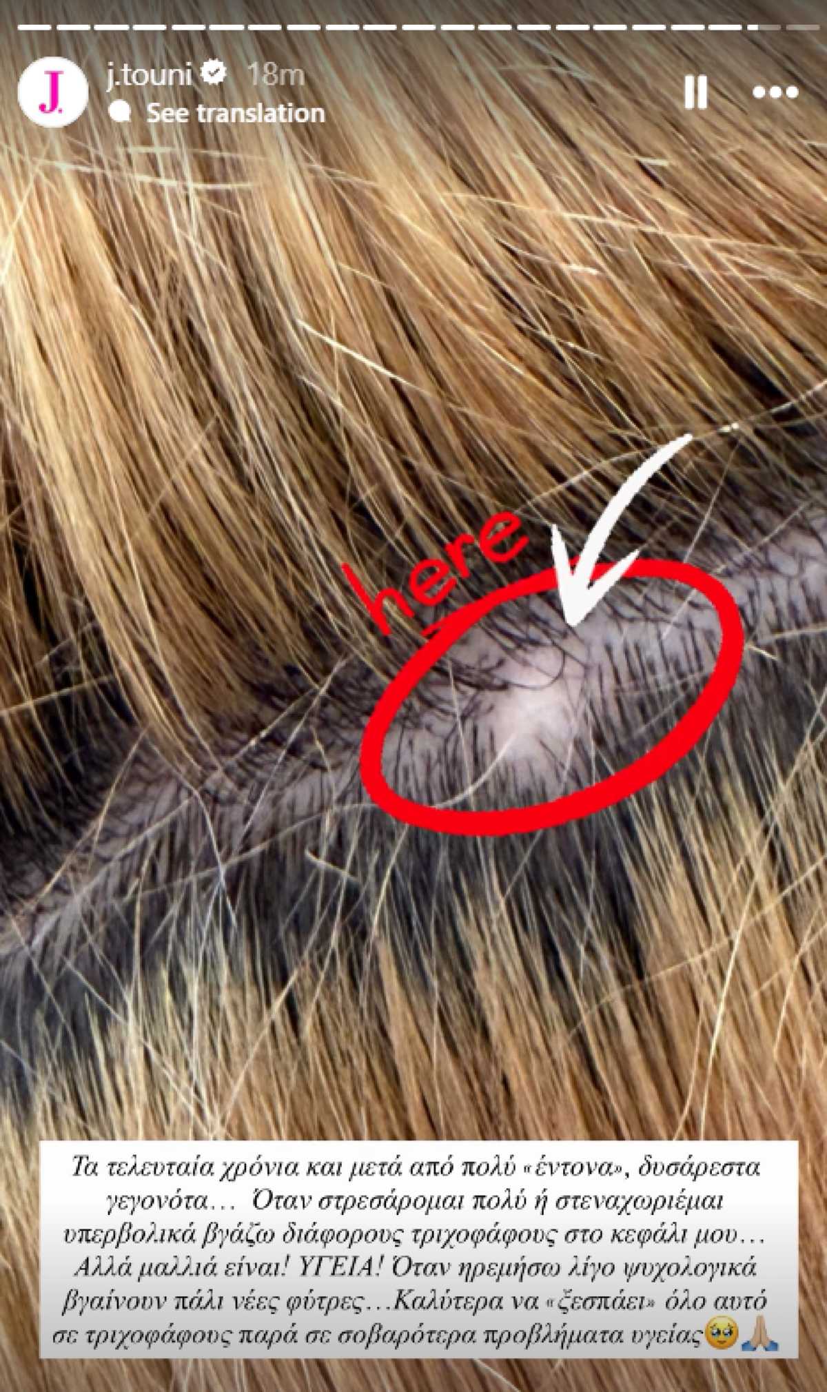 Ιωάννα Τούνη τριχοφάγος