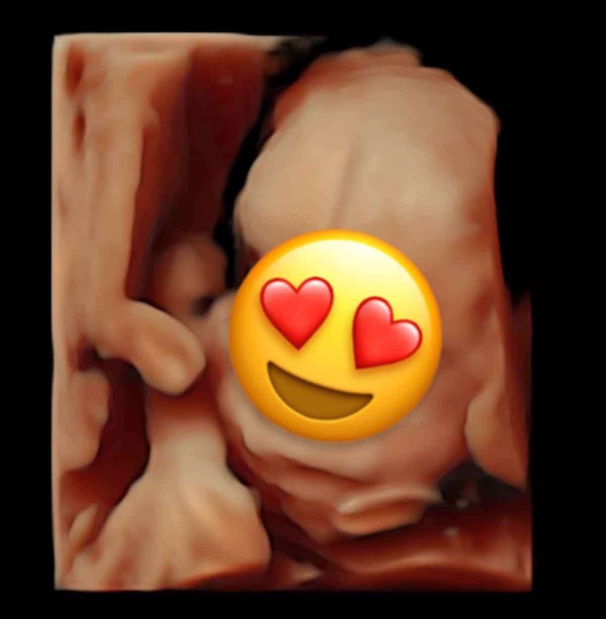 Το υπερηχογράφημα της Πωλίνας Τριγωνίδου