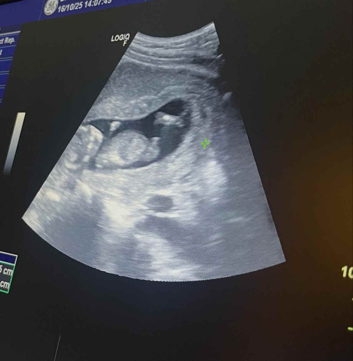 Το υπερηχογράφημα της Πωλίνας Τριγωνίδου