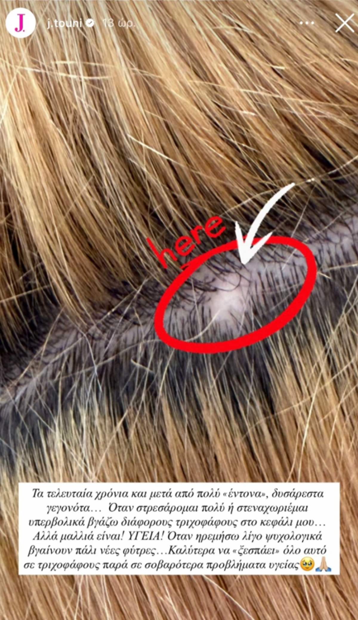 Ιωάννα Τούνη αυτοάνοσο μαλλιά