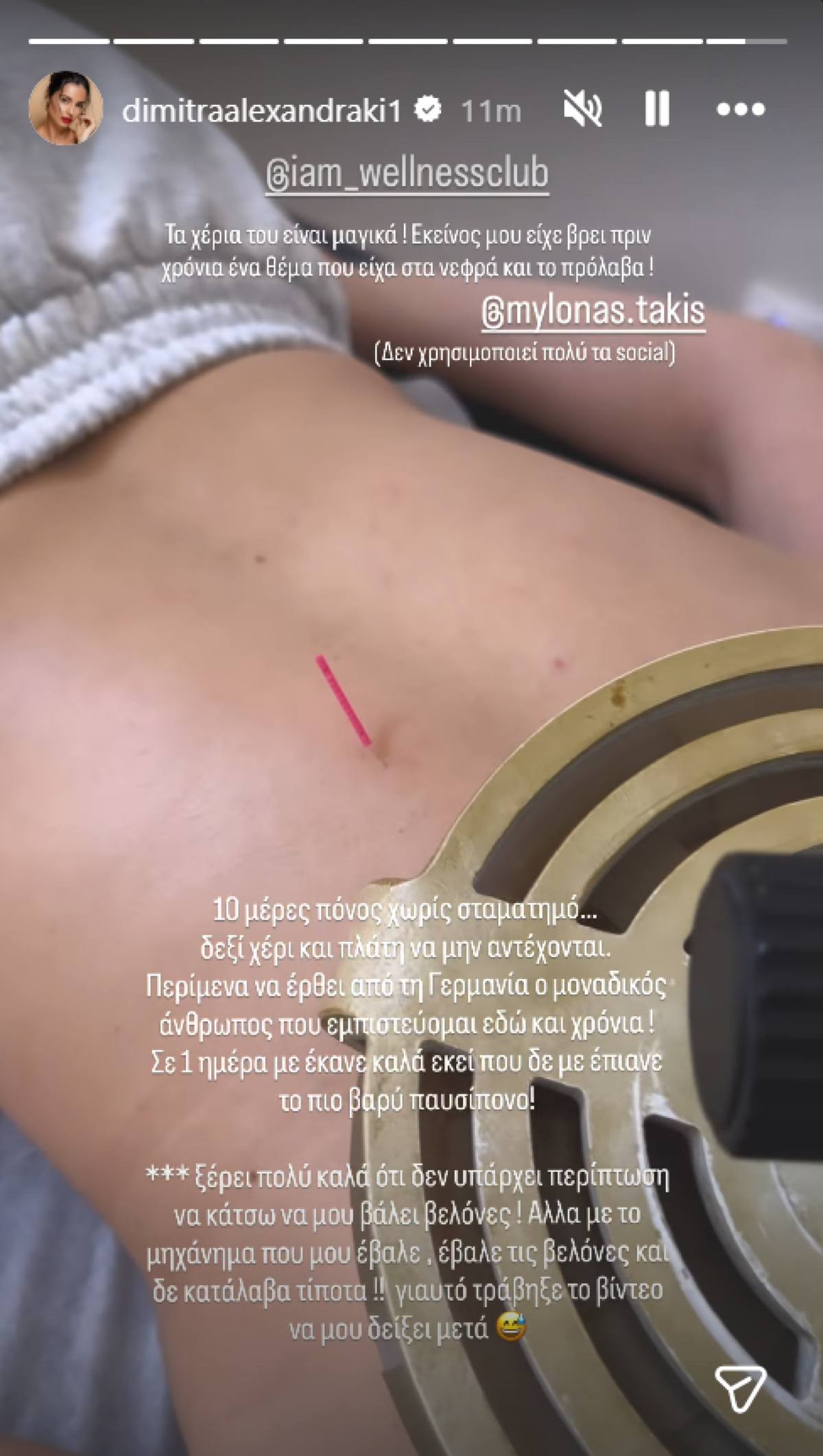 Η Δήμητρα Αλεξανδράκη κάνει βελονισμό