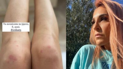 Γιάννα Τερζή αυτοάνοσο